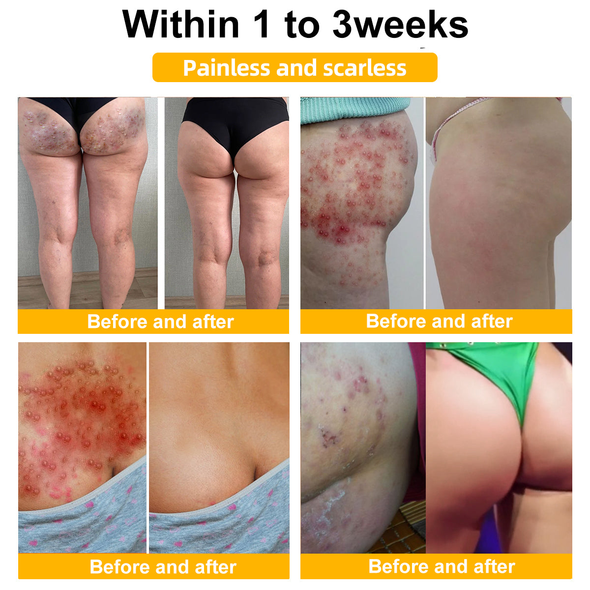 🐝BUY 1 GET 1 FREE🐝Bee Venom Mole and Wart Treatment Cream🍃[👨‍⚕AAD RECOMMENDS]