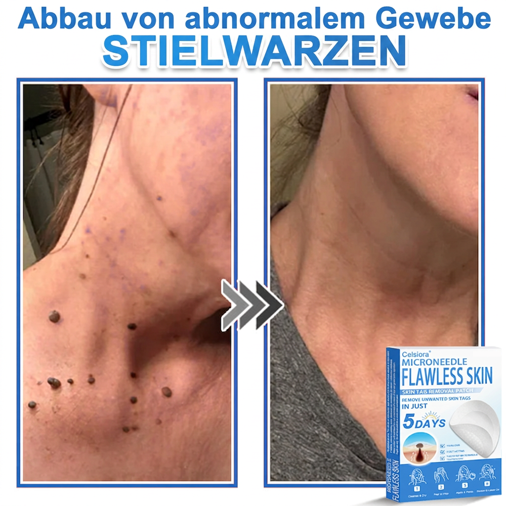 ⭐Celsiora® 2-in-1 Mikronadel- & Hydrokolloid-Pflaster | Entferner für erhabene Muttermale, Akne, flache Warzen & Hautanhängsel | Verbessert Falten, Narben & Hautunreinheiten | Unsichtbare Stern-Pickelpflaster für Gesicht & Körper