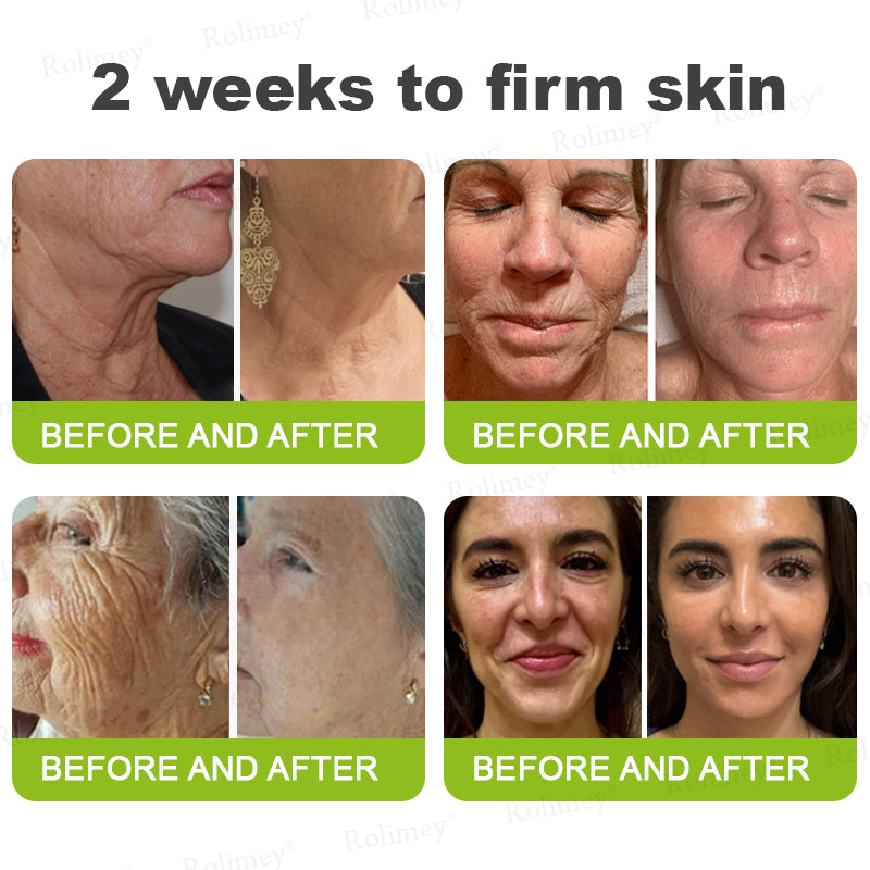 ✨👨‍⚕️♦️Made and shipped from the UK 💫Rolimey® Botox & Vita-A Retinol Shot Wrinkle-Lift Tightening cream - Last Day Promotion 70% OFF