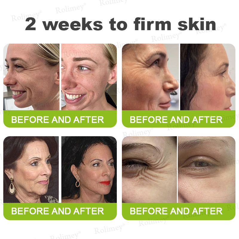 ✨👨‍⚕️♦️Made and shipped from the UK 💫Rolimey® Botox & Vita-A Retinol Shot Wrinkle-Lift Tightening cream - Last Day Promotion 70% OFF