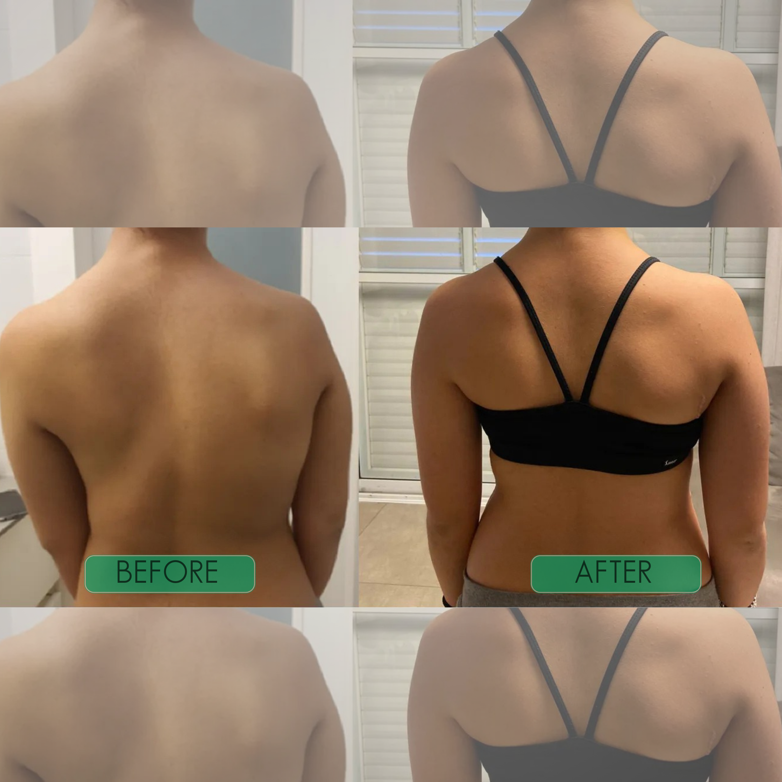 🔥nstant Posture Corrector Limited  Offer: Buy 1 Get 1 Free ✅Add 2 items to cart to activate offer