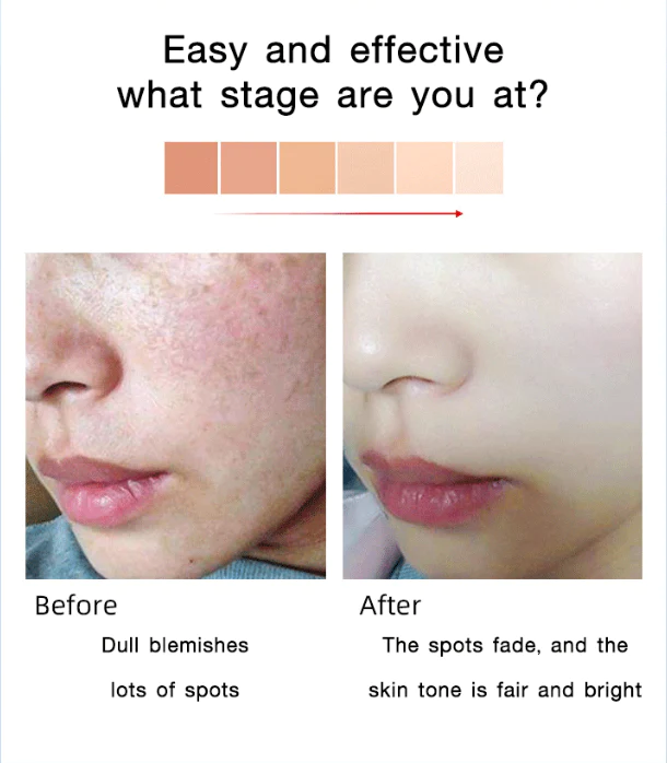  WHITENING ANTI-FRECKLE MOISTURIZING CREAM