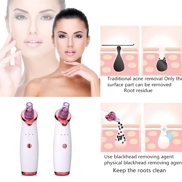 Blackhead and Acne Remover