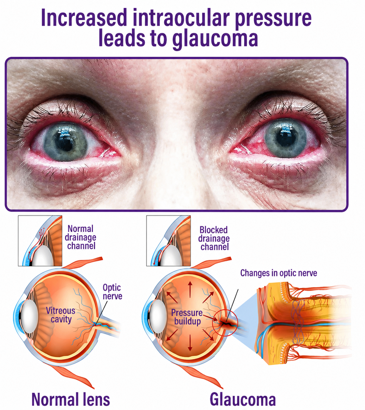 Visiolife® Transdermal Vision-Repair Eye Microneedle Patch✅FDA Approved(Suitable for presbyopia, dry eye syndrome, glaucoma, and cataracts)
