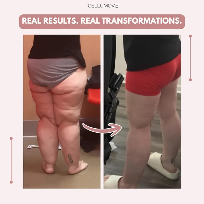 Cellumove 3D legging - say goodbye to lipedema pain and swelling naturally