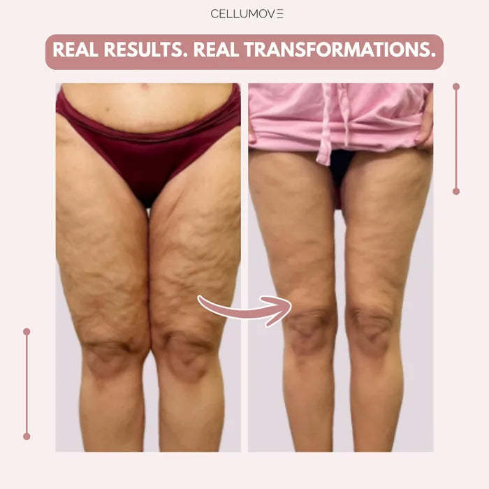 Cellumove 3D legging - say goodbye to lipedema pain and swelling naturally