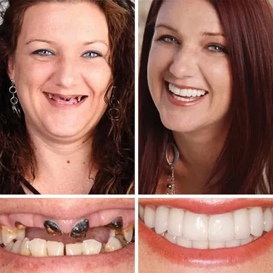 Adaptable Fit Denture Kit – Functional Denture Set with Denture Cleaner, Comfortable Fit, Daily Denture Care Solution