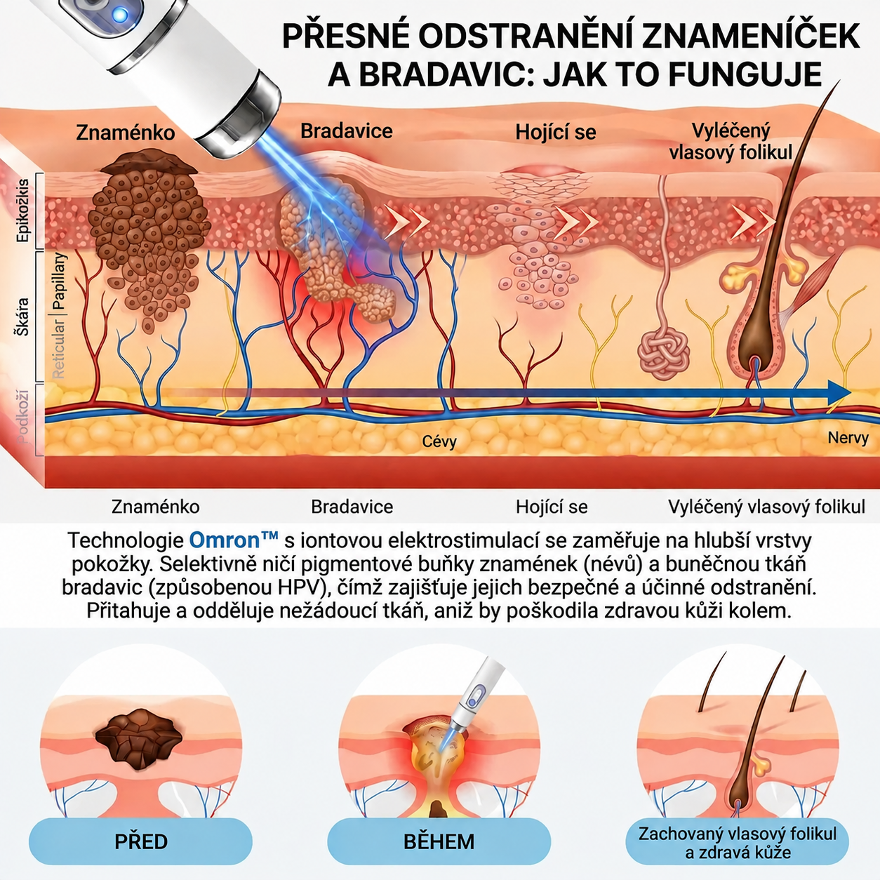 ✨ Omron™ 2026 – Multifunkční péče o pleť nové generace v peru: profesionální řešení pro odstranění znamének a nedokonalostí. Neinvazivní technologie bez bolesti a bez jizev pro zdravější a zářivější pleť. Vyrobeno v USA. ✨