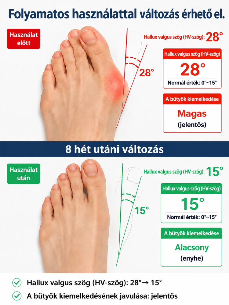 Láthatatlan Ultra-vékony Bütyökkorrigáló Pánt | Nappali Viselésre Cipőben is | Állítható Hallux Valgus Védő