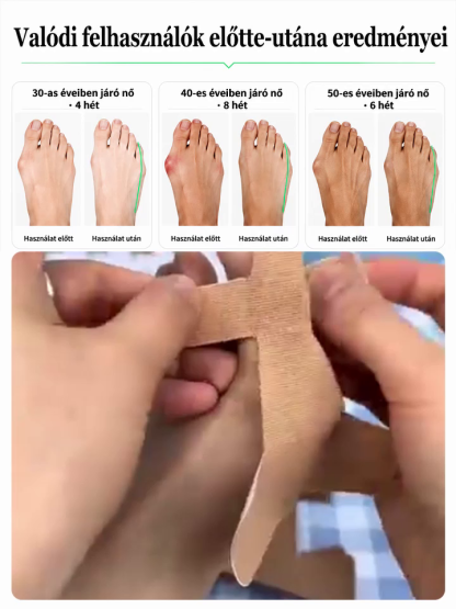 Láthatatlan Ultra-vékony Bütyökkorrigáló Pánt | Nappali Viselésre Cipőben is | Állítható Hallux Valgus Védő