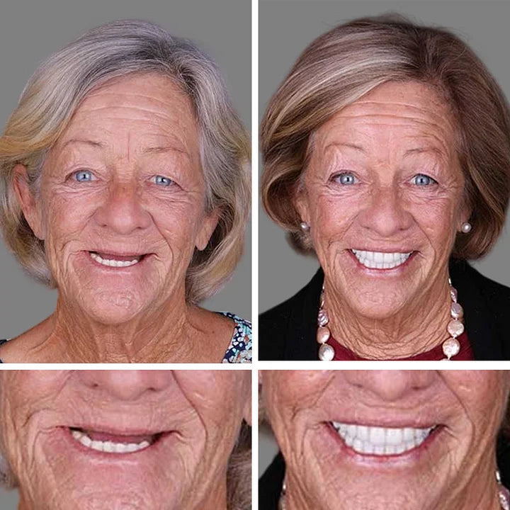 😁🦷Goodutensil™ Complete Dentures , Strong Bonding-Rediscover the joy of chewing and radiate a confident smile