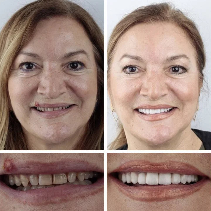 😁🦷Goodutensil™ Complete Dentures , Strong Bonding-Rediscover the joy of chewing and radiate a confident smile