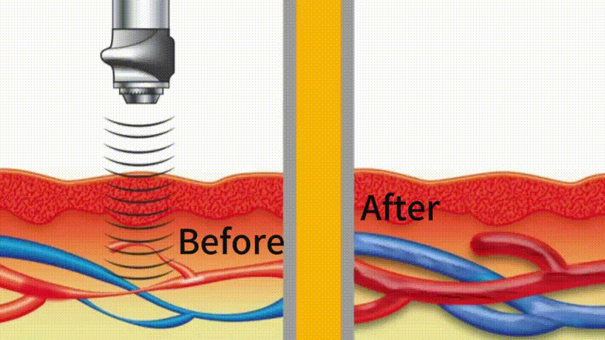 Knight Sword™ Pulse-Wave Technology