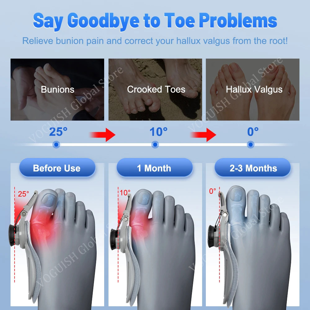 THIS DISCOUNT IS FOR YOU : Bunion Splint Corrector Big Toe Straightener