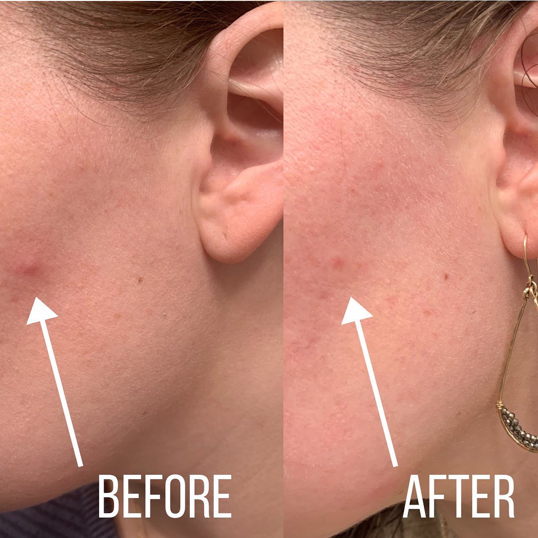 Hydrocolloid Acne Patch Roll