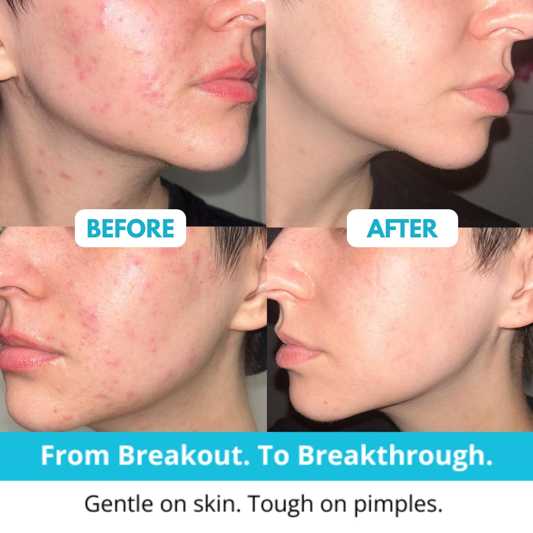 Hydrocolloid Acne Patch Roll