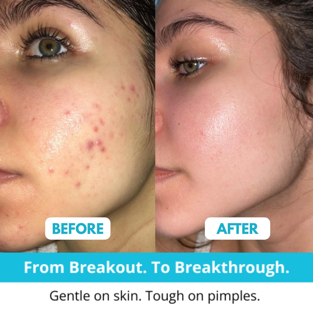 Hydrocolloid Acne Patch Roll