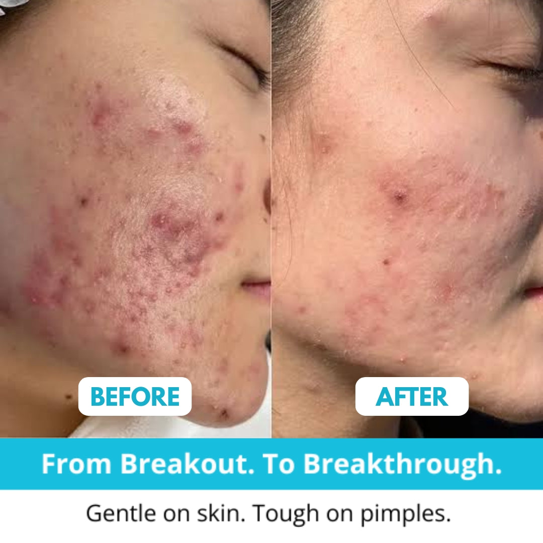 Hydrocolloid Acne Patch Roll
