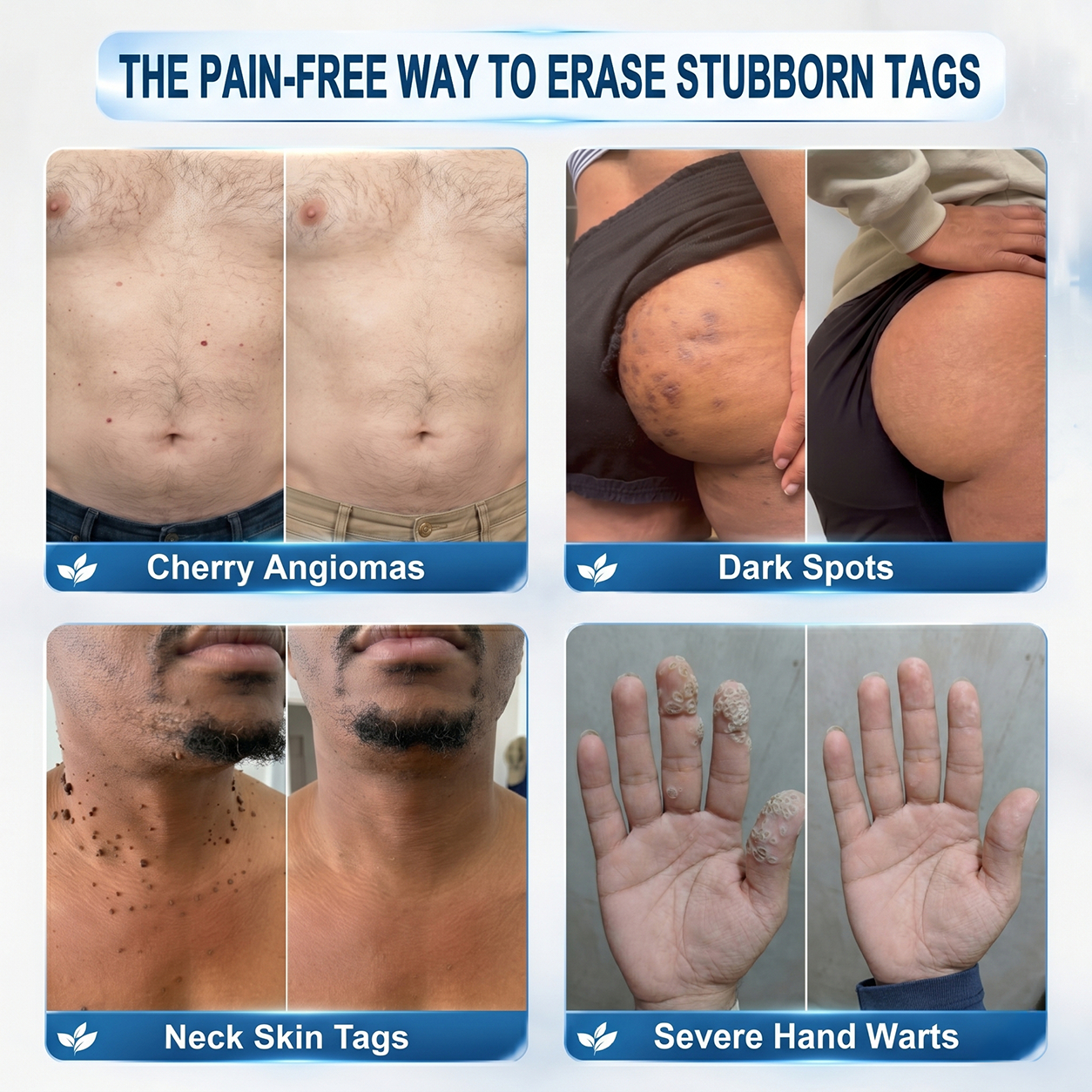 7-Day Skin Tag & Spot Eraser Painless & Scar-Free Advanced Imperfection Removal Rollerball Pen