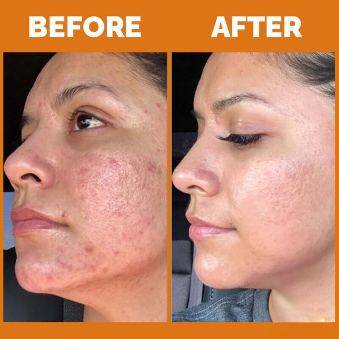 Teashell Niacinamide Brightening Serum | Fade Dark Spots, Acne Marks & Even Skin Tone