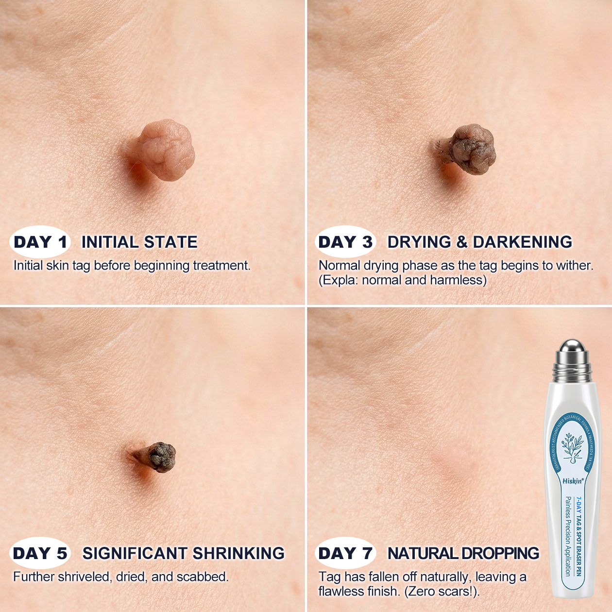 7-Day Skin Tag & Spot Eraser Painless & Scar-Free Advanced Imperfection Removal Rollerball Pen