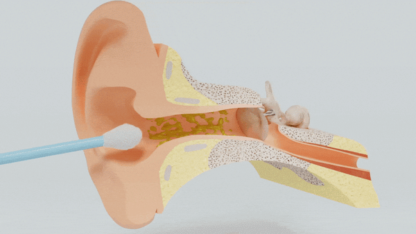 Q-Grips Earwax Removal Kit