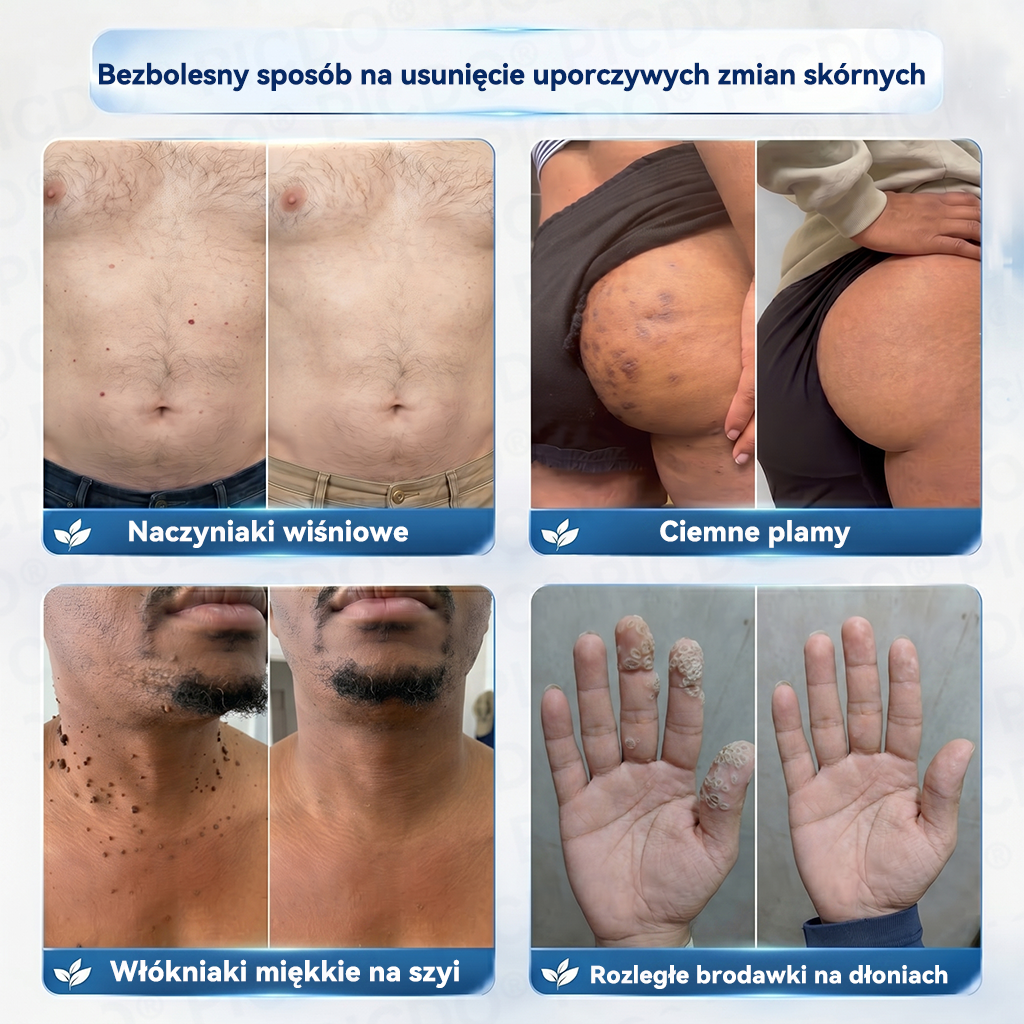  𝐏𝐢𝐜𝐝𝐨® 7-𝐃𝐧𝐢𝐨𝐰𝐲 𝐊𝐫𝐞𝐦 𝐝𝐨 𝐔𝐬𝐮𝐰𝐚𝐧𝐢𝐚 𝐁𝐫𝐨𝐝𝐚𝐰𝐞𝐤 𝐢 𝐍𝐢𝐞𝐝𝐨𝐬𝐤𝐨𝐧𝐚𝐥𝐨ś𝐜𝐢 𝐒𝐤ó𝐫𝐲🩵 (𝑭𝒐𝒓𝒎𝒖ł𝒂 𝑩𝒆𝒛 𝑩ó𝒍𝒖 𝒊 𝑩𝒆𝒛 𝑩𝒍𝒊𝒛𝒏) 💪