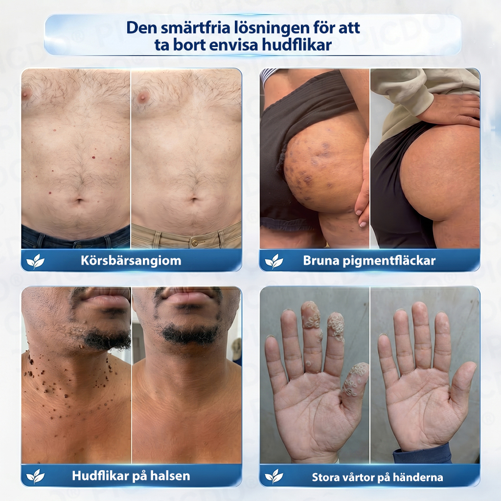 𝐏𝐢𝐜𝐝𝐨® 7-dagars Hudfliks- & Fläckborttagningskräm (Noll Smärta, Noll Ärr Formula) 🌹