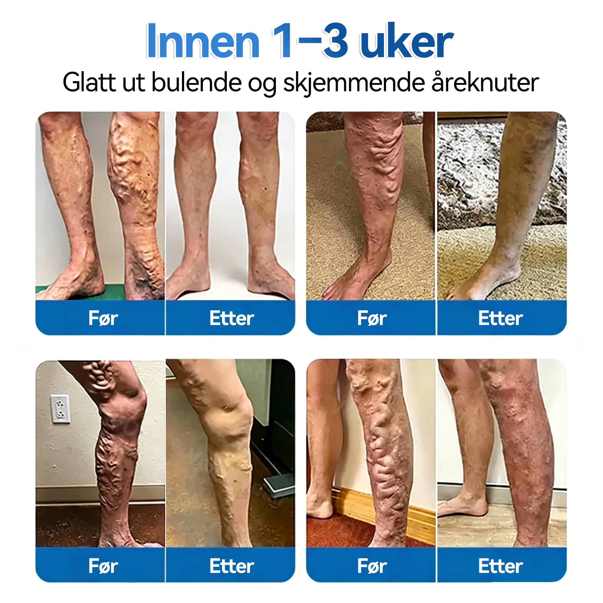 NO🍁💖𝐅𝐥𝐨𝐫𝐢𝐬𝐦𝐚® 𝐕𝐞𝐧𝐞𝐫𝐞𝐩𝐚𝐫𝐚𝐬𝐣𝐨𝐧 𝐑𝐮𝐥𝐥 𝐌𝐞𝐝 𝐌𝐢𝐤𝐫𝐨𝐧å𝐥𝐩𝐥𝐚𝐬𝐭𝐞𝐫⚡Øyeblikkelig lindring, langsiktige resultater