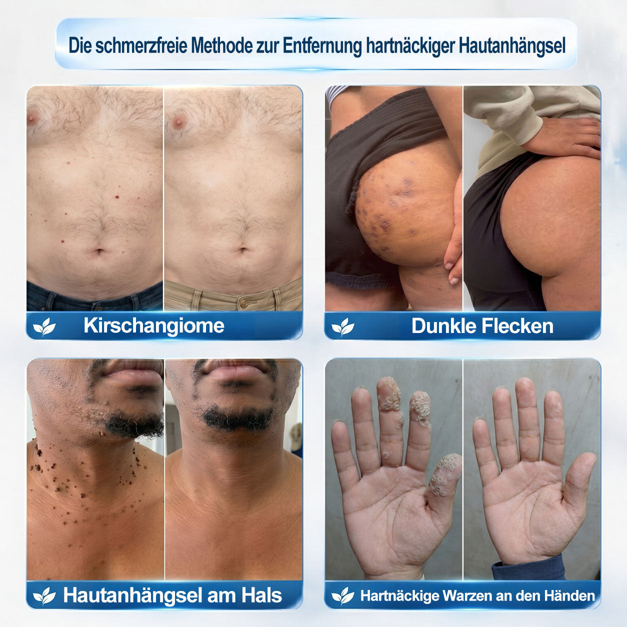 🇩🇪𝐎𝐟𝐟𝑖𝑧𝑖𝒆𝒍𝒍𝒆𝒓 𝑴𝒂𝗋𝗄𝖾𝗇𝘴𝘵𝘰𝘳𝘦|✅𝗣𝗶𝒄𝒅𝐨® 𝟕-𝑇𝖺𝗀𝗲 𝐹𝑙𝖾𝖼𝘬𝘦𝘯- & 𝑯𝖺𝒖𝗍𝖺𝗇𝗁ä𝘯𝘨𝘴𝘦𝘭-𝐸𝑛𝑡𝖿𝖾𝗋𝘯𝘦𝘳 (Schmerzfrei, Narbenfrei Rollerball)🎉