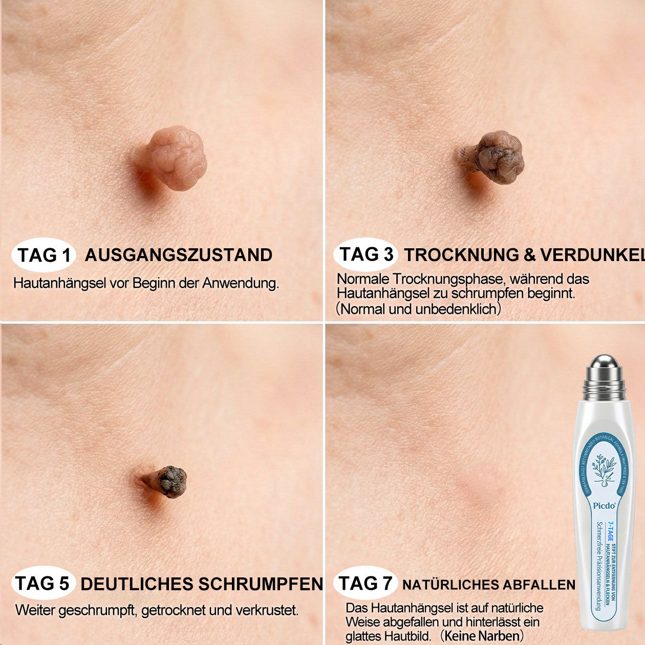 🇩🇪𝐎𝐟𝐟𝑖𝑧𝑖𝒆𝒍𝒍𝒆𝒓 𝑴𝒂𝗋𝗄𝖾𝗇𝘴𝘵𝘰𝘳𝘦|✅𝗣𝗶𝒄𝒅𝐨® 𝟕-𝑇𝖺𝗀𝗲 𝐹𝑙𝖾𝖼𝘬𝘦𝘯- & 𝑯𝖺𝒖𝗍𝖺𝗇𝗁ä𝘯𝘨𝘴𝘦𝘭-𝐸𝑛𝑡𝖿𝖾𝗋𝘯𝘦𝘳 (Schmerzfrei, Narbenfrei Rollerball)🎉