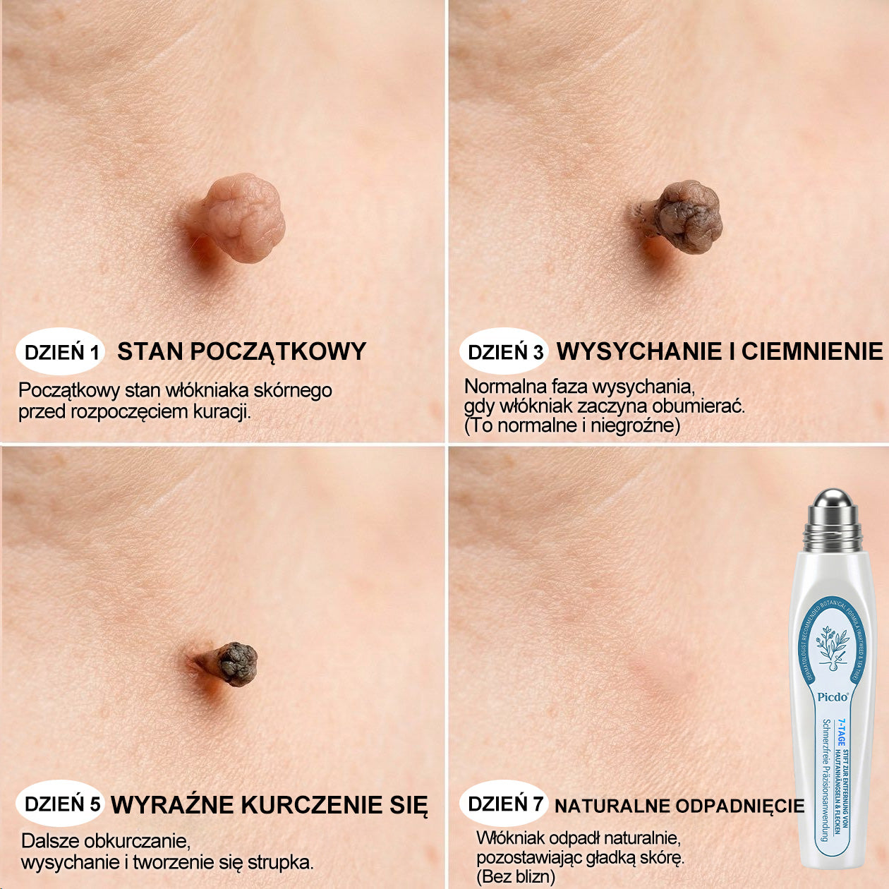 𝐏i𝐜𝐝o® 7 𝑫𝒏𝒊 𝑷𝒓𝒆𝒑𝒂𝒓𝒂𝒕 𝑫𝒐 𝑼𝒔𝒖𝒘𝒂𝒏𝒊𝒂 𝑾łó𝒌𝒏𝒊𝒂𝒌ó𝒘 𝑴𝒊ę𝒌𝒌𝒊𝒄𝒉 𝑰 𝑷𝒓𝒛𝒆𝒃𝒂𝒓𝒘𝒊𝒆ń(𝐁𝐞𝐳 𝐁ó𝐥𝐮, 𝐁𝐞𝐳 𝐁𝐥𝐢𝐳𝐧 – 𝐑𝐨𝐥𝐥-𝐨𝐧)💪