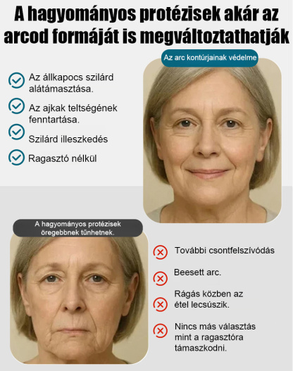 Elasztikus fogsorbetét pillanatok alatt tökéletes mosolyt ad!