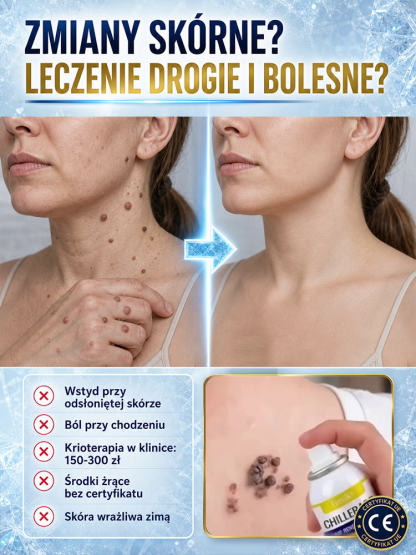 Precyzyjny Spray Kriogeniczny do Pielęgnacji Skóry -55°C z Technologią Cryo-Shield – Błyskawiczne Wymrażanie Niedoskonałości w 3 Sekundy, Bez Bólu i Śladów