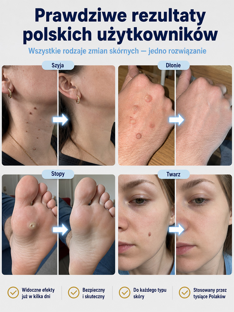 Precyzyjny Spray Kriogeniczny do Pielęgnacji Skóry -55°C z Technologią Cryo-Shield – Błyskawiczne Wymrażanie Niedoskonałości w 3 Sekundy, Bez Bólu i Śladów