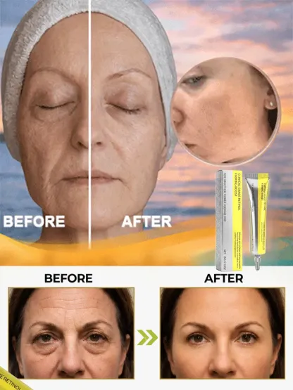 👁️ Dermatologist-Tested Clinical Retinol Eye Cream Lifts Wrinkles In 7 Days – 50% OFF Flash Sale With 30-Day Free Trial & 10x Ineffective Payout Guarantee!