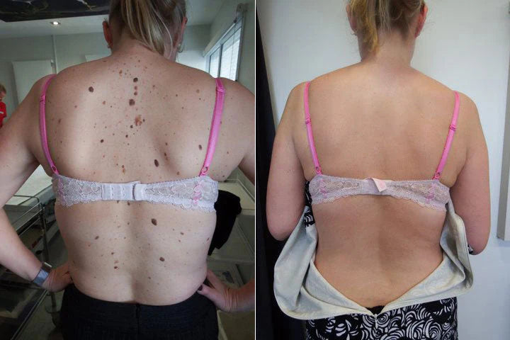 Back skin improvement