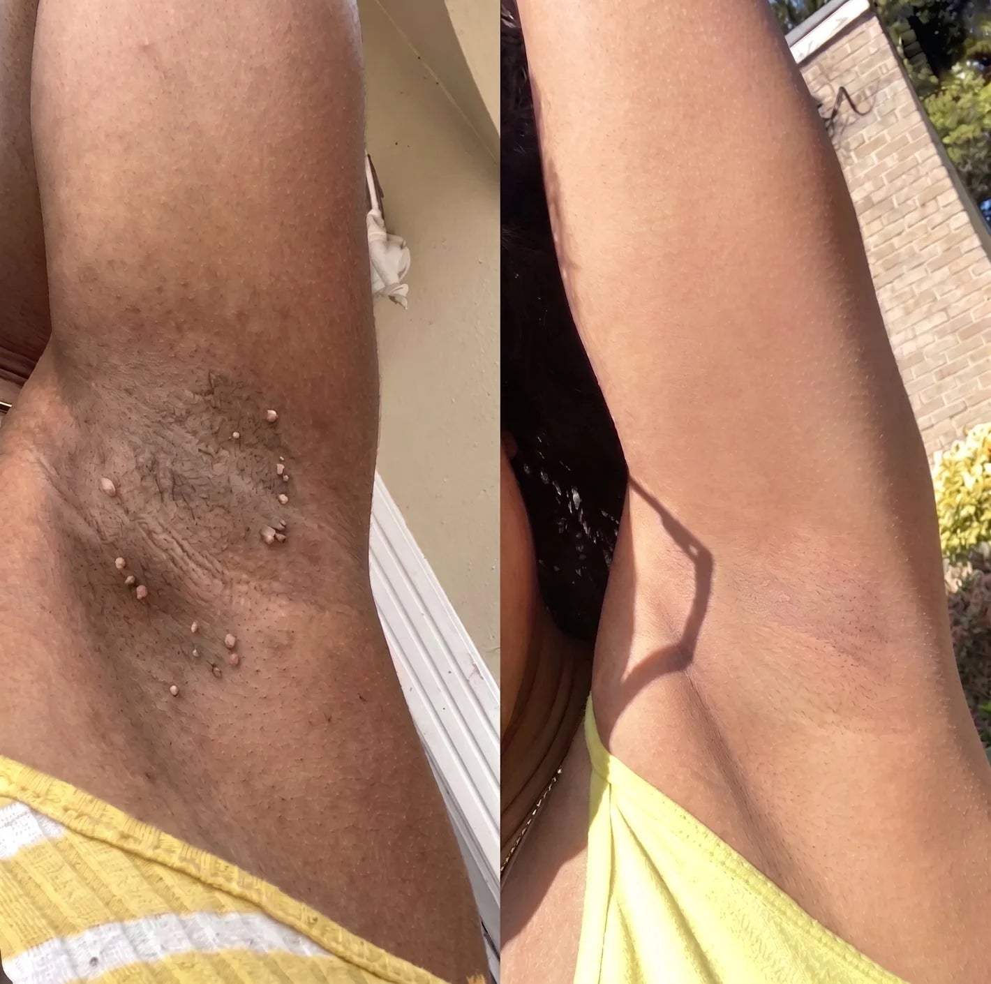Underarm improvement