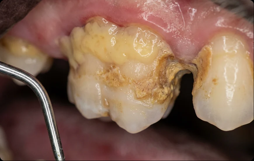 Close-up illustration of dental plaque and tartar