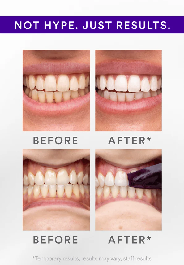 V34 Whitening Strips-Aldronix