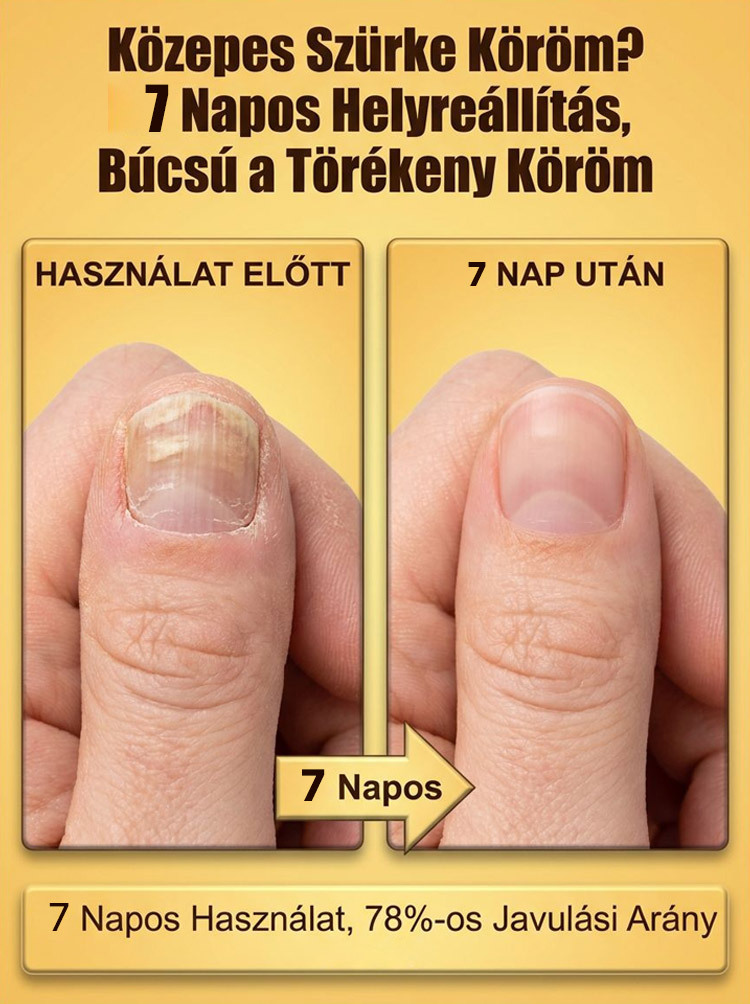 7 Napos Méhméreg Köröm-Helyreállító Cseppek | 50% Kedvezmény + Ingyenes Szállítás