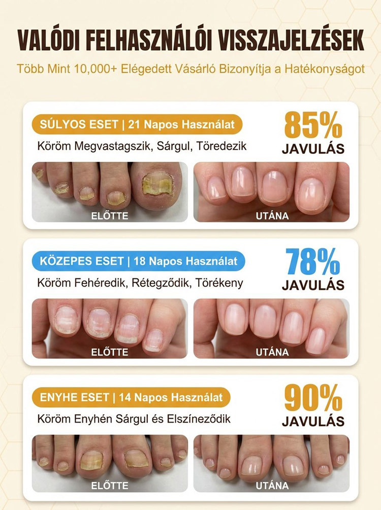 7 Napos Méhméreg Köröm-Helyreállító Cseppek | 50% Kedvezmény + Ingyenes Szállítás