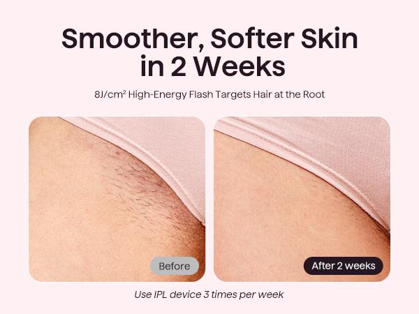 Wavytalk Bare It IPL Hair Removal with Ice Cooling, 3 Modes & 24J Dual-Pulse for Salon-Level Results on Face, Body & Bikini, Painless & Precise