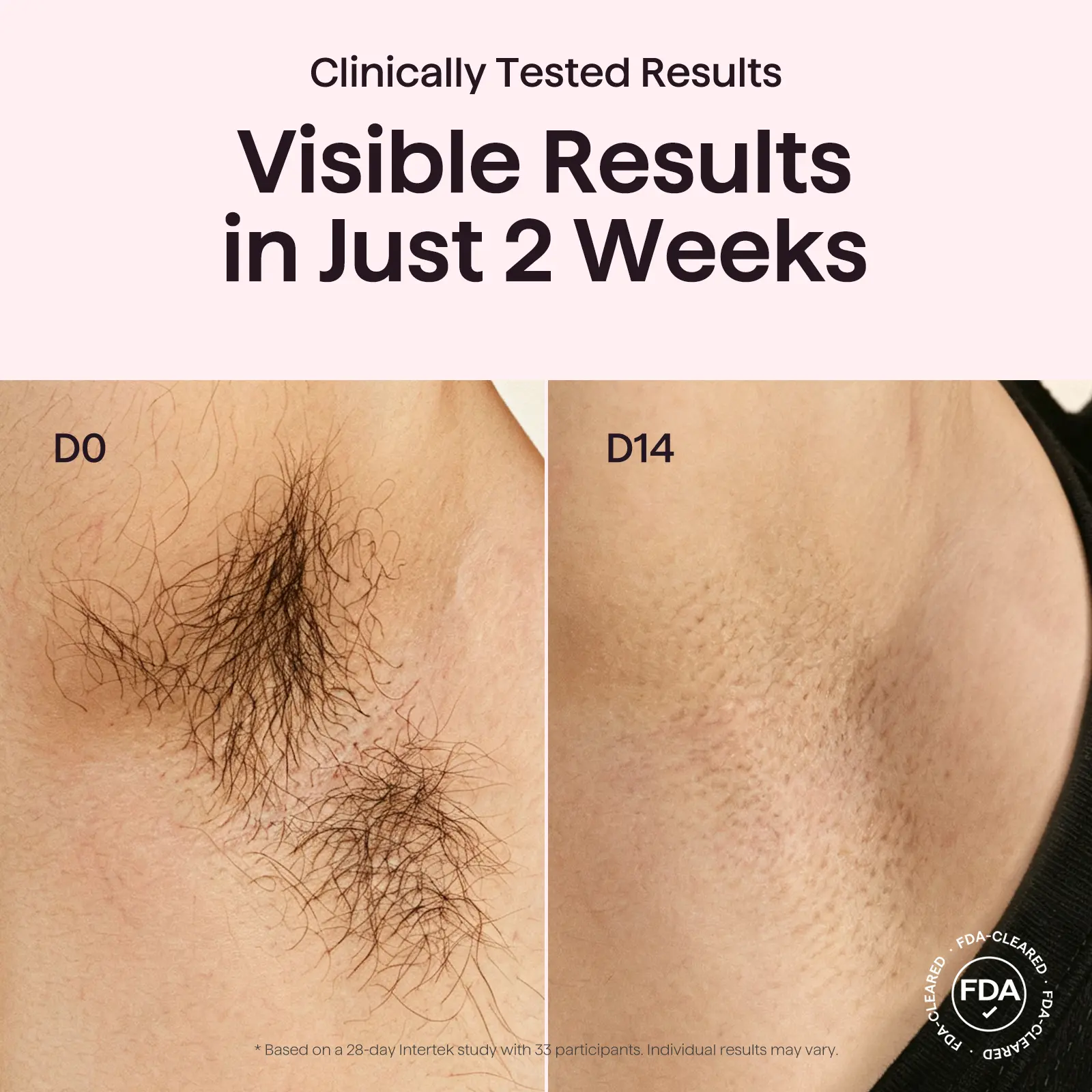 Hair Removal with Ice Cooling