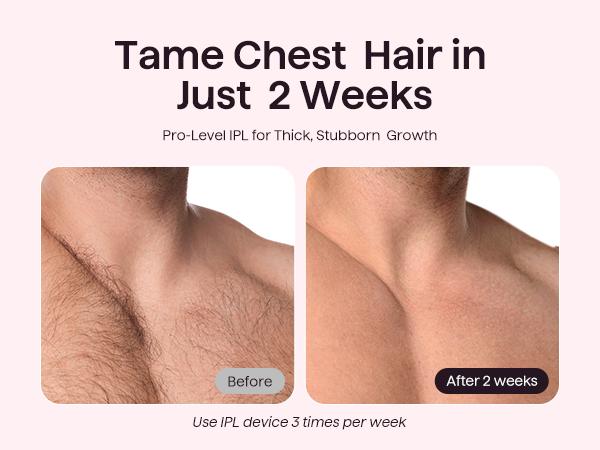 Wavytalk Bare It IPL Hair Removal with Ice Cooling, 3 Modes & 24J Dual-Pulse for Salon-Level Results on Face, Body & Bikini, Painless & Precise