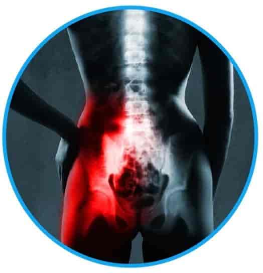 SI Joint dysfunction