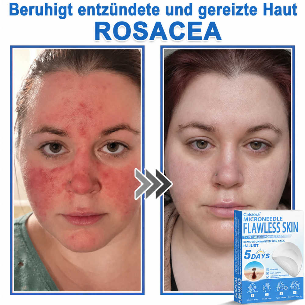 ⭐Celsiora® 2-in-1 Mikronadel- & Hydrokolloid-Pflaster | Entferner für erhabene Muttermale, Akne, flache Warzen & Hautanhängsel | Verbessert Falten, Narben & Hautunreinheiten | Unsichtbare Stern-Pickelpflaster für Gesicht & Körper