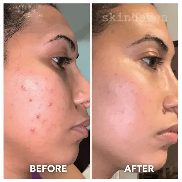 Face Mask Light Therapy 