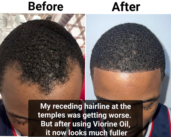 Vital Strands Batana Oil for Hair Growth – 100% Pure & Organic Batana Oil from Honduras – Cold Pressed Raw Scalp & Hair Treatment for Men & Women – 50ml
