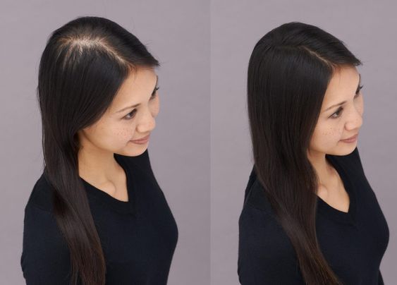 Natural Human Hair Topper | Straight Style丨Perm-able丨Silk & Lace Base | 9'' * 9'' Base丨 Give You a Brand New Look